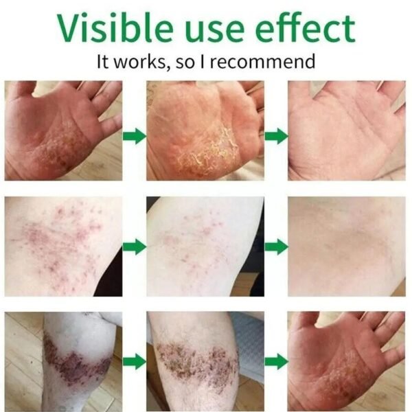 🌿 SuniFun Herbal Psoriasis & Eczema Relief Cream✨